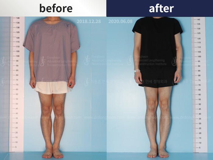 Tibial lengthening