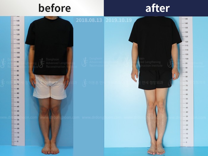Tibial lengthening