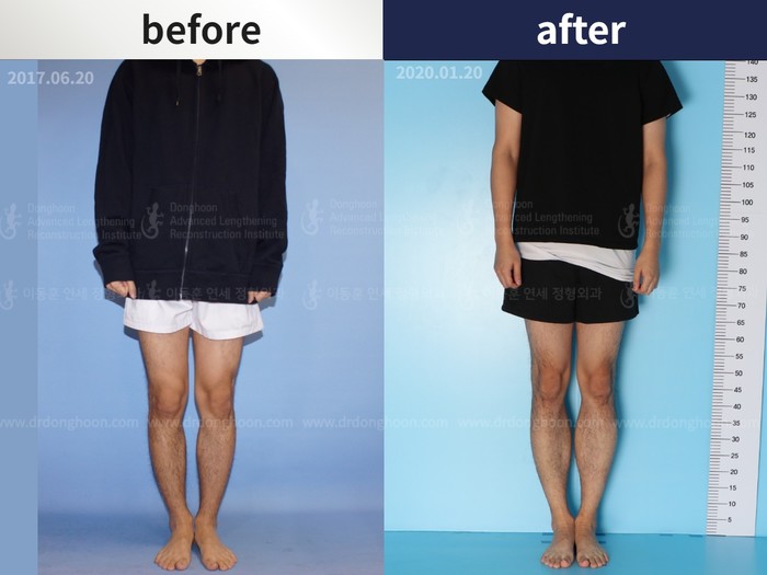 Tibial lengthening