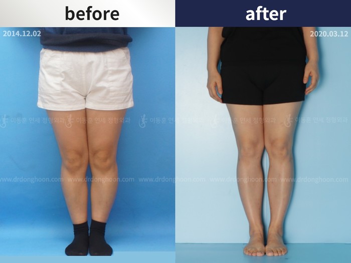 Tibial lengthening, 6 cm gained