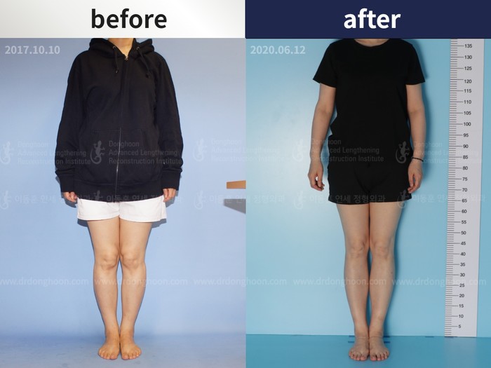 Tibial lengthening