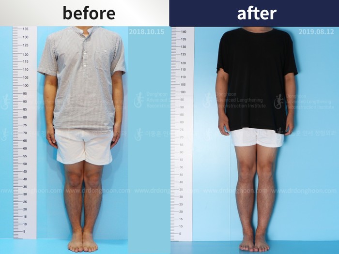 Tibial lengthening, 6.2 cm gained