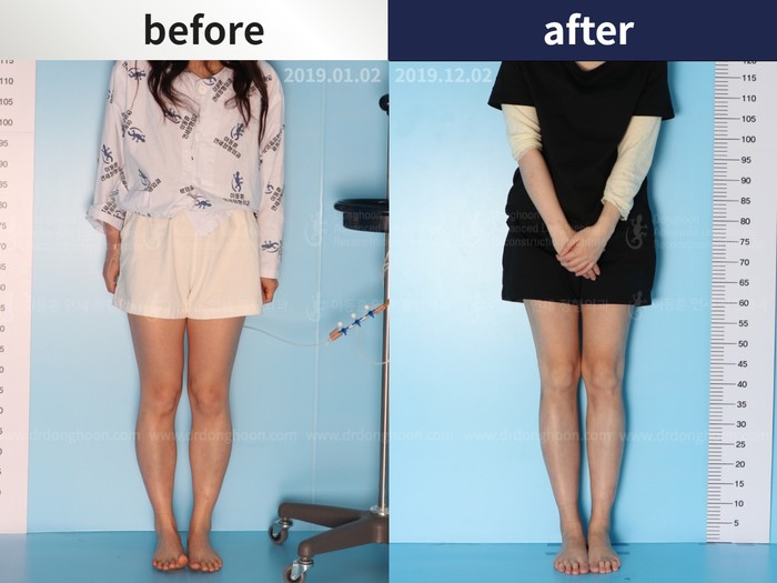 Tibial lengthening, 6.9 cm gained