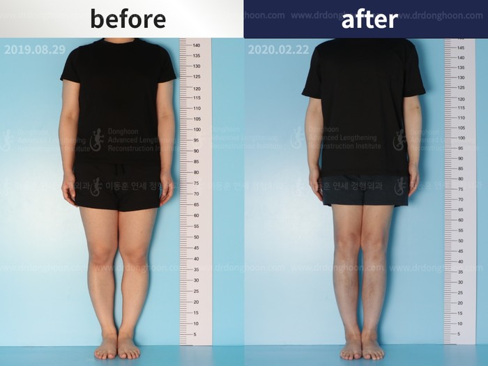 Tibial lengthening