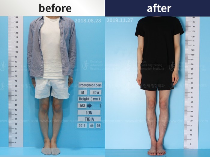 Tibial lengthening, 5.8 cm gained
