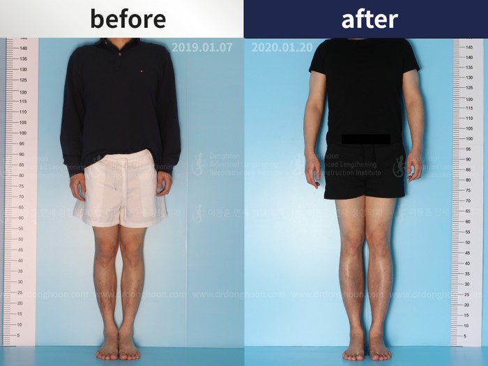 Tibial lengthening, 6.2 cm gained