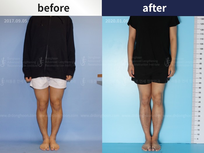 Tibial lengthening