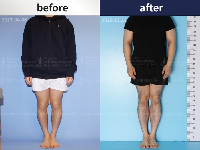 Tibial lengthening