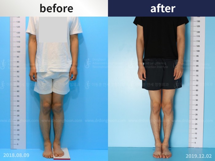 Femoral lengthening