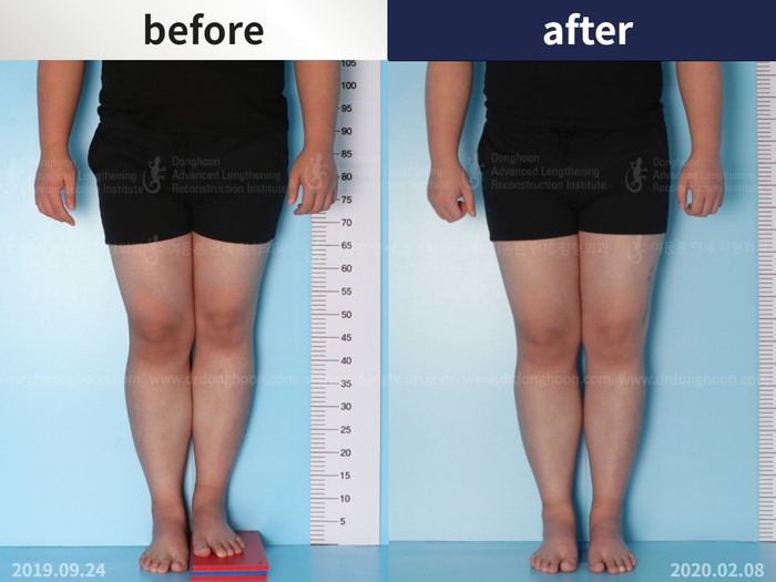 Femoral lengthening, 3 cm gained