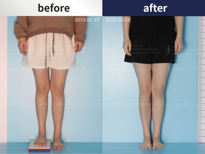 Tibial lengthening, 3 cm gained