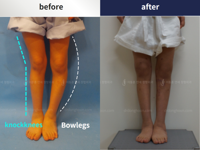 Paediatric congenital condition