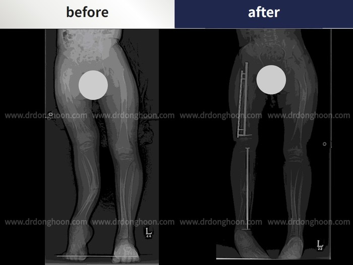 Femoral + tibial lengthening