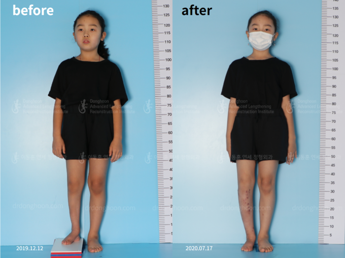 Paediatric congenital condition
