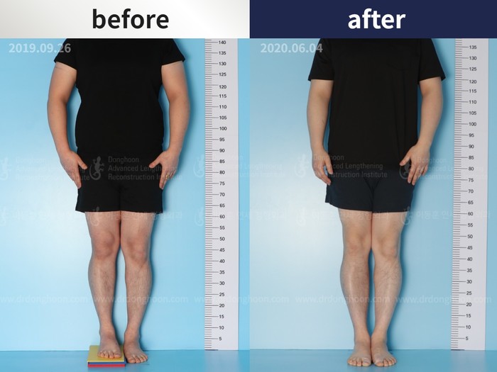 Tibial lengthening, 2.3 cm gained