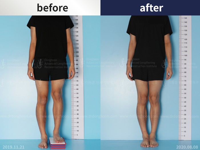 Femoral lengthening, 5.5 cm gained