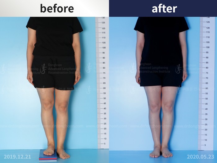 Femoral lengthening, 3.5 cm gained