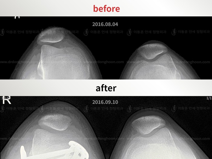 Recurrent patella dislocation