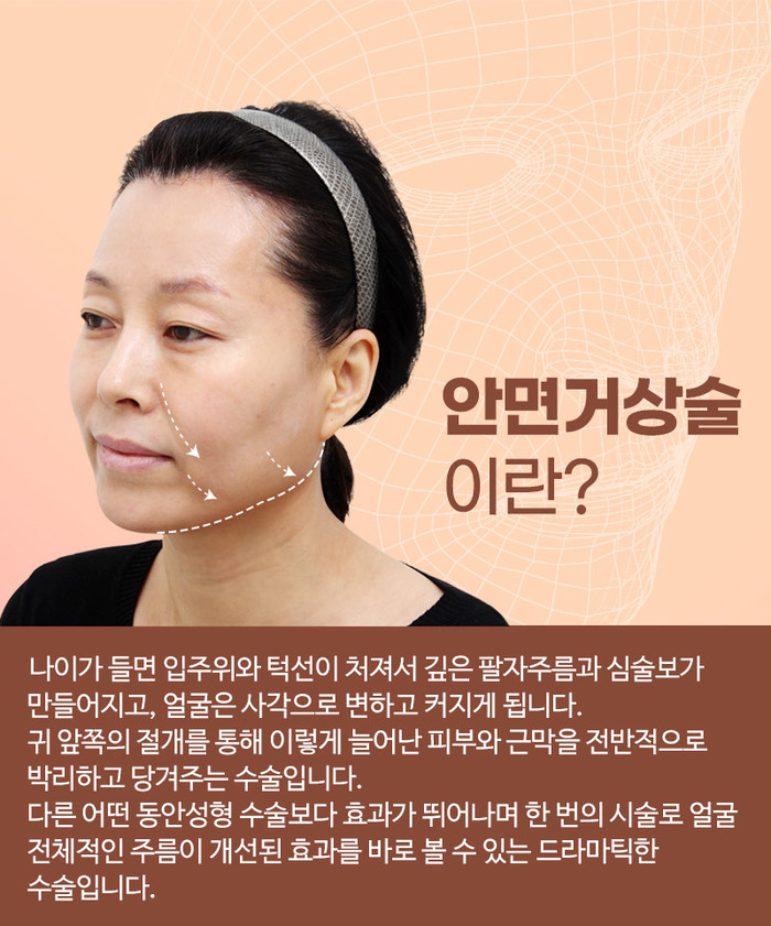 프레쉬성형외과 안면거상술