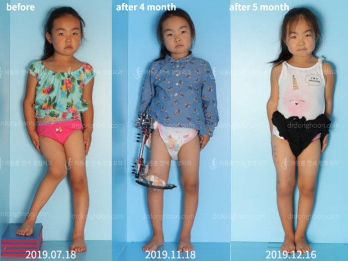 Paediatric & adolescent LLD