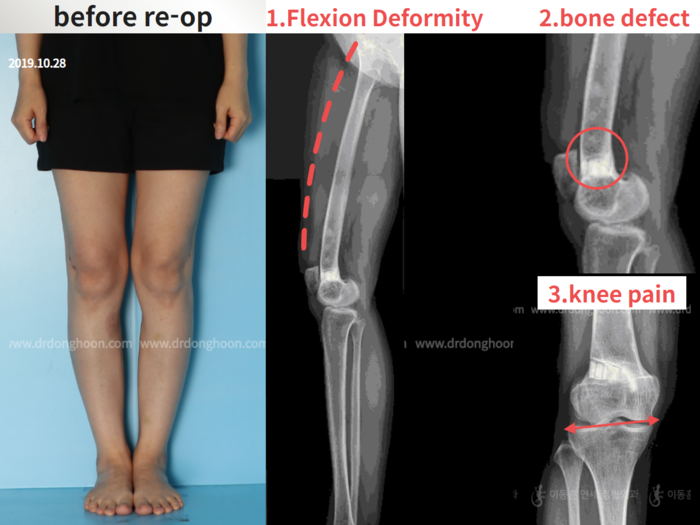 Reoperation after deformity correction