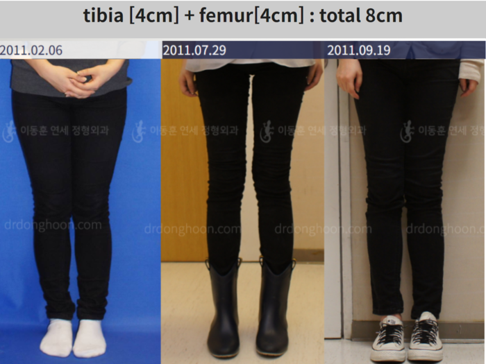Femoral + tibial lengthening, 4 cm gained