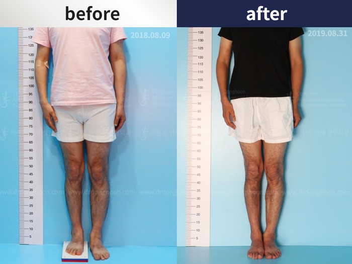 Tibial lengthening, 2.3 cm gained