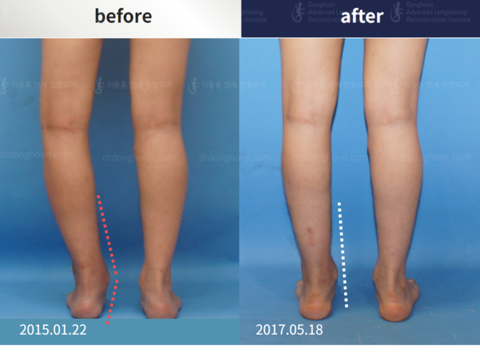 Foot & ankle deformity