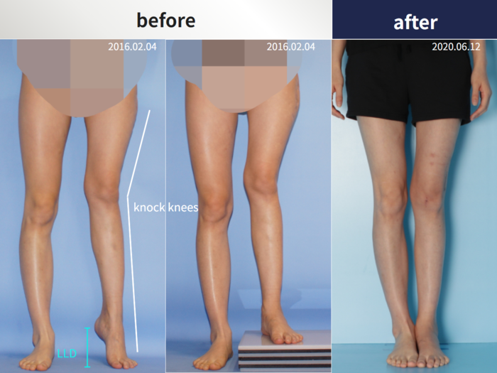 Femoral lengthening, 6 cm gained