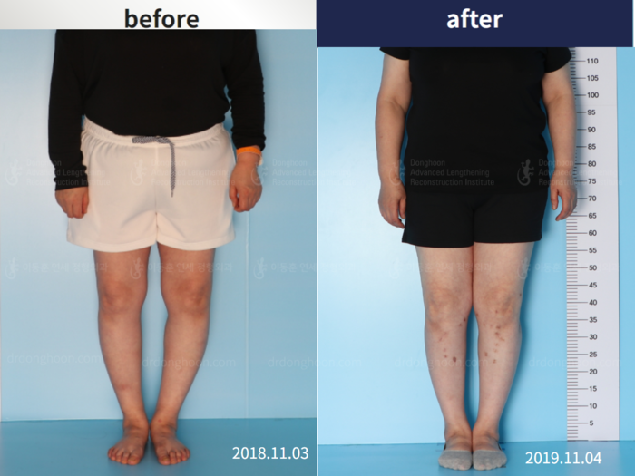 ผ่าตัดจัดแนวขาสำหรับเข่าเสื่อม