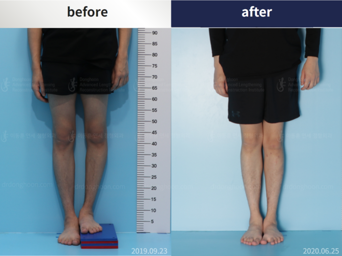 Femoral + tibial lengthening, 2 cm gained
