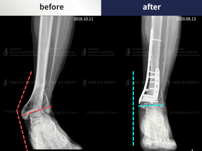 Foot & ankle deformity