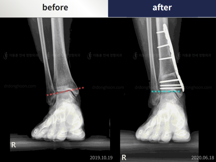 Foot & ankle deformity