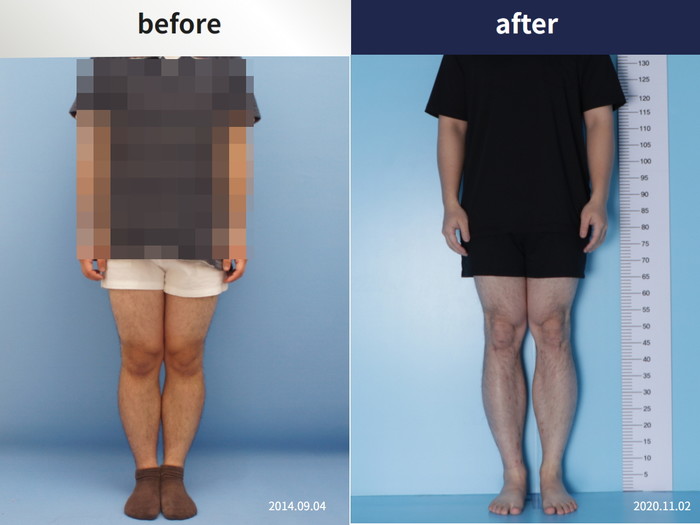 Tibial lengthening