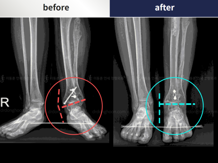 Foot & ankle deformity