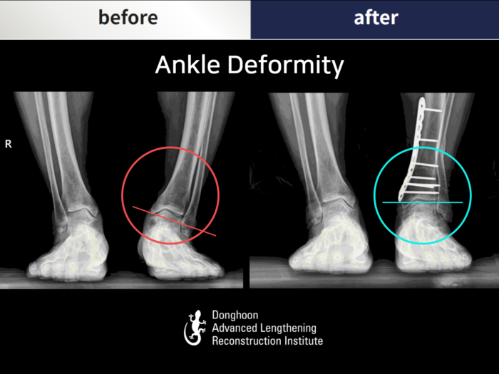Foot & ankle deformity