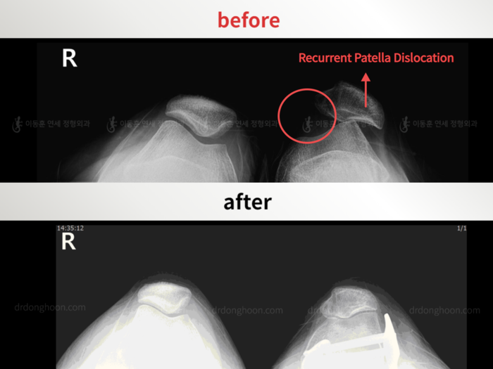Recurrent patella dislocation