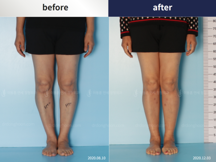 Osteotomy for knee osteoarthritis