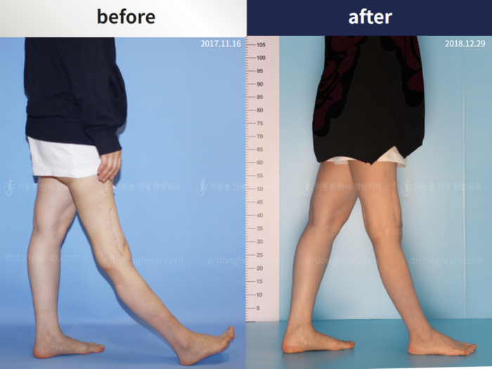 Complex & post-trauma deformity before and after radiograph example 1