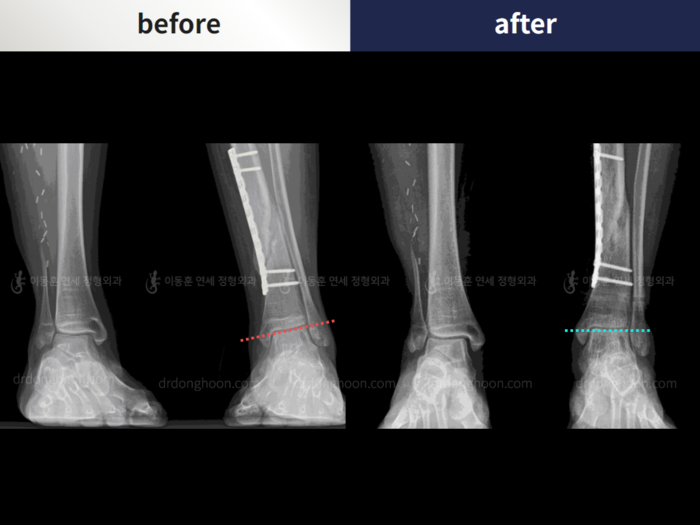 Foot & ankle deformity