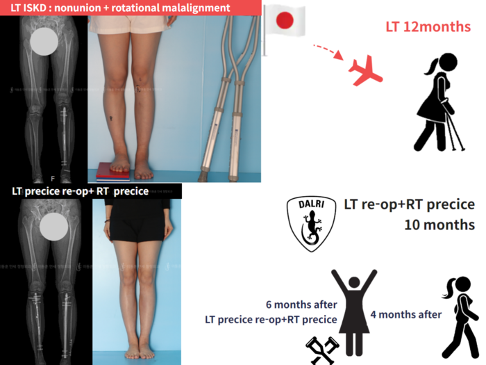 Tibial lengthening