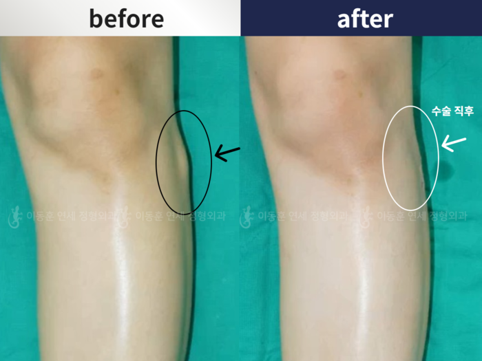 Protruded fibular head
