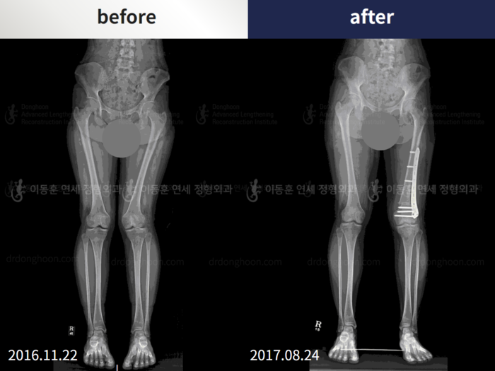 ยืดกระดูกต้นขา