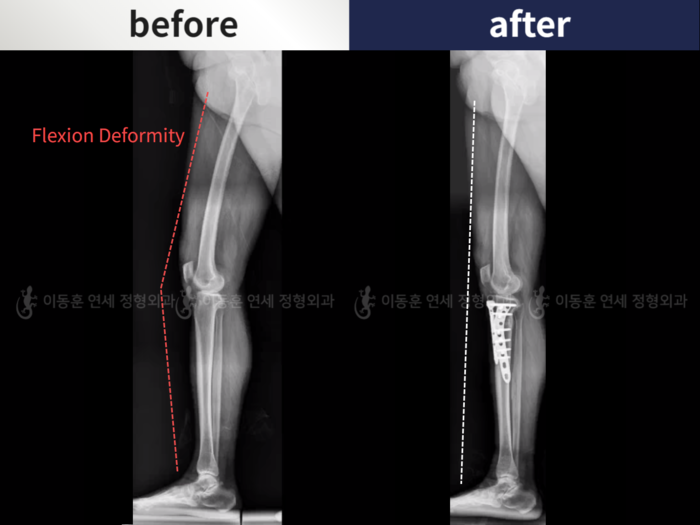 Flexion deformity