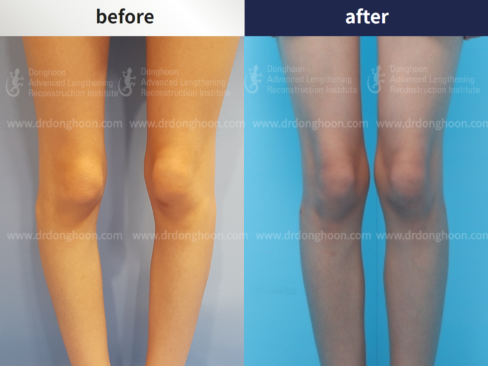 Congenital & paediatric conditions before and after radiograph example 3