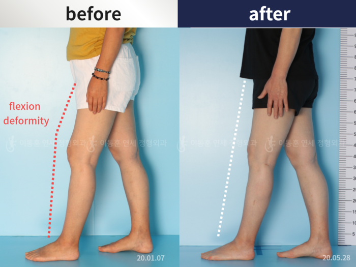 Flexion deformity