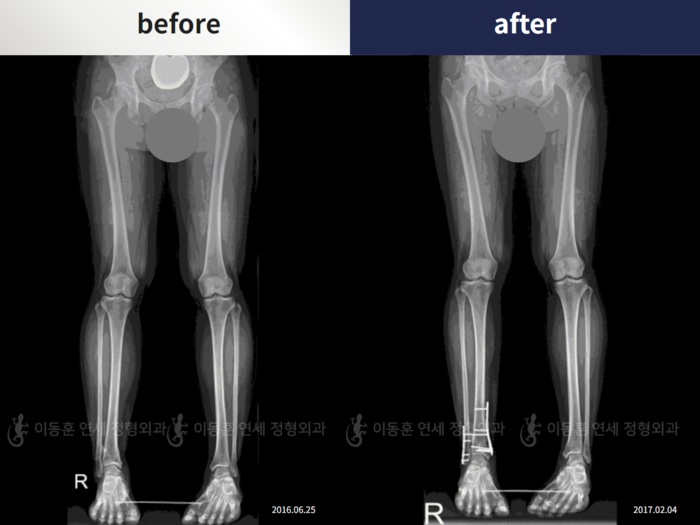 Foot & ankle deformity