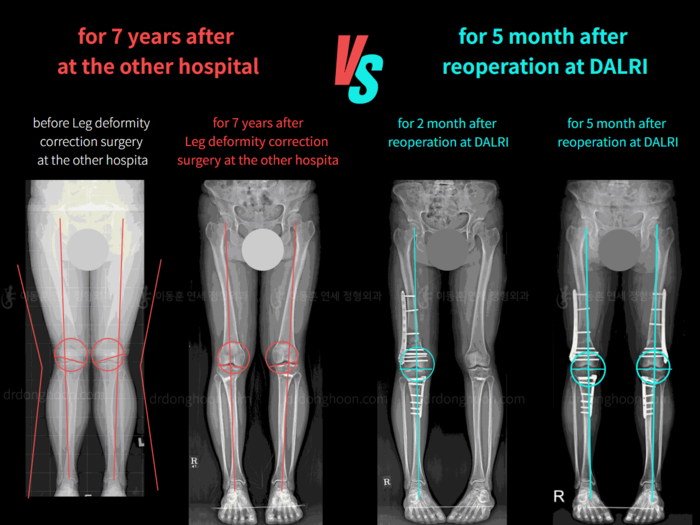 Femoral + tibial lengthening