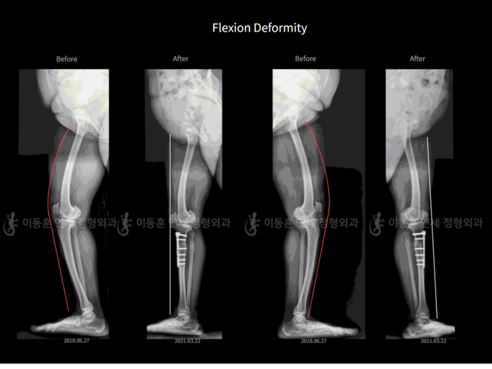 Flexion deformity