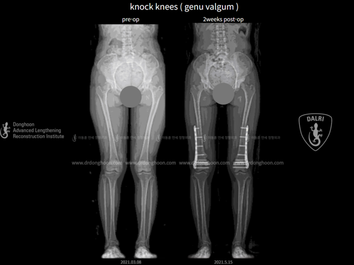 Adult knock knees